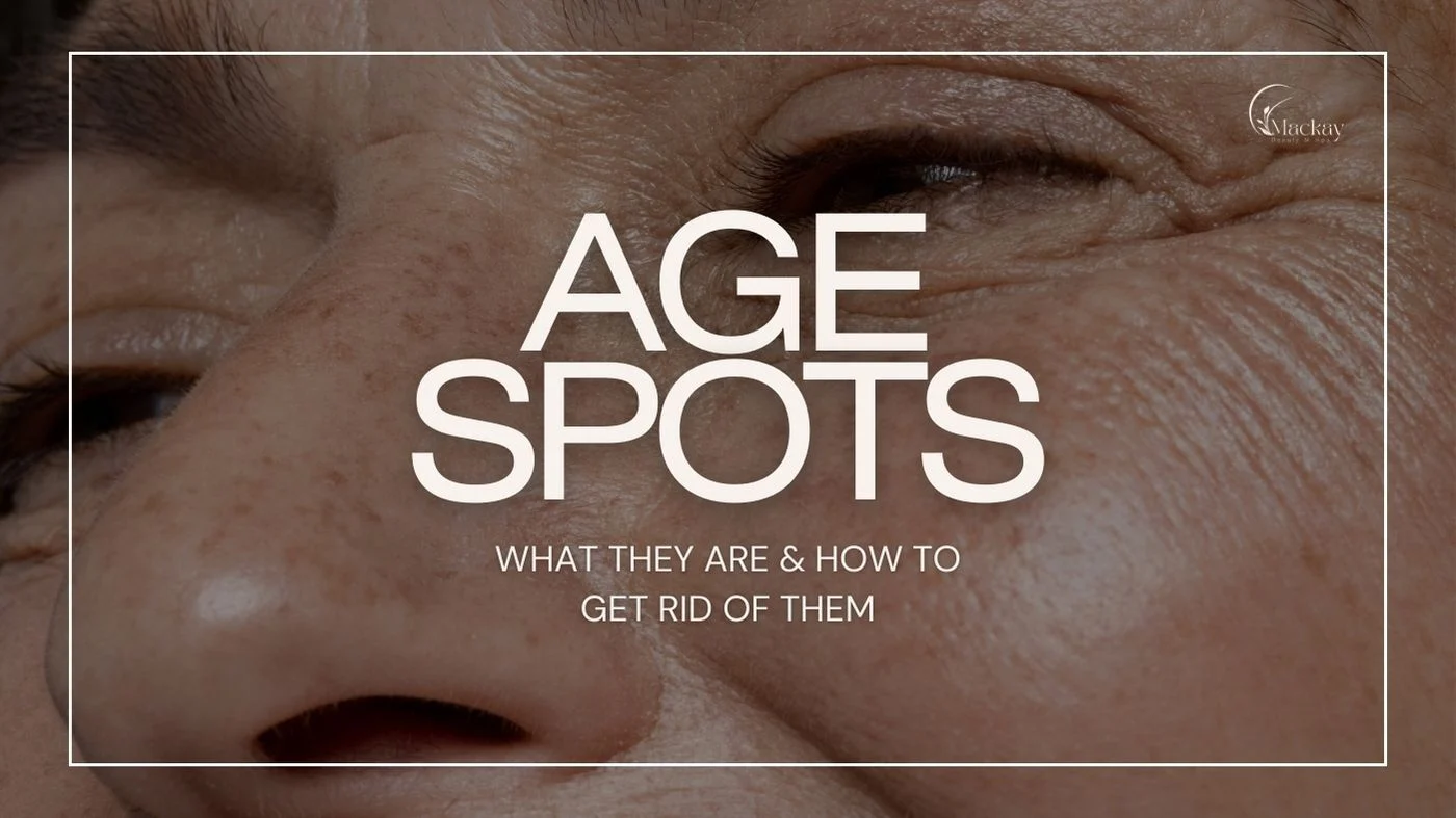 Age Spots Guide: Causes, Prevention & Treatments