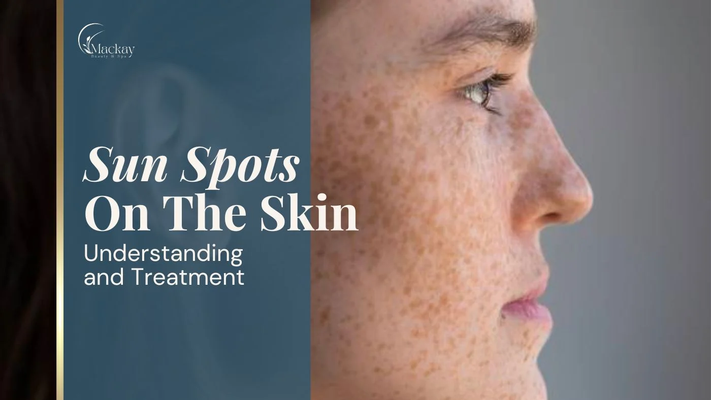 Sun_spots_on_the_skin