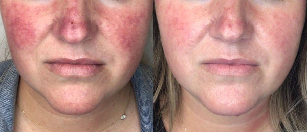 Lumecca IPL before and after example 14