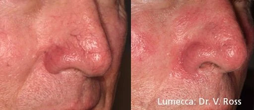 Lumecca IPL before and after example 28