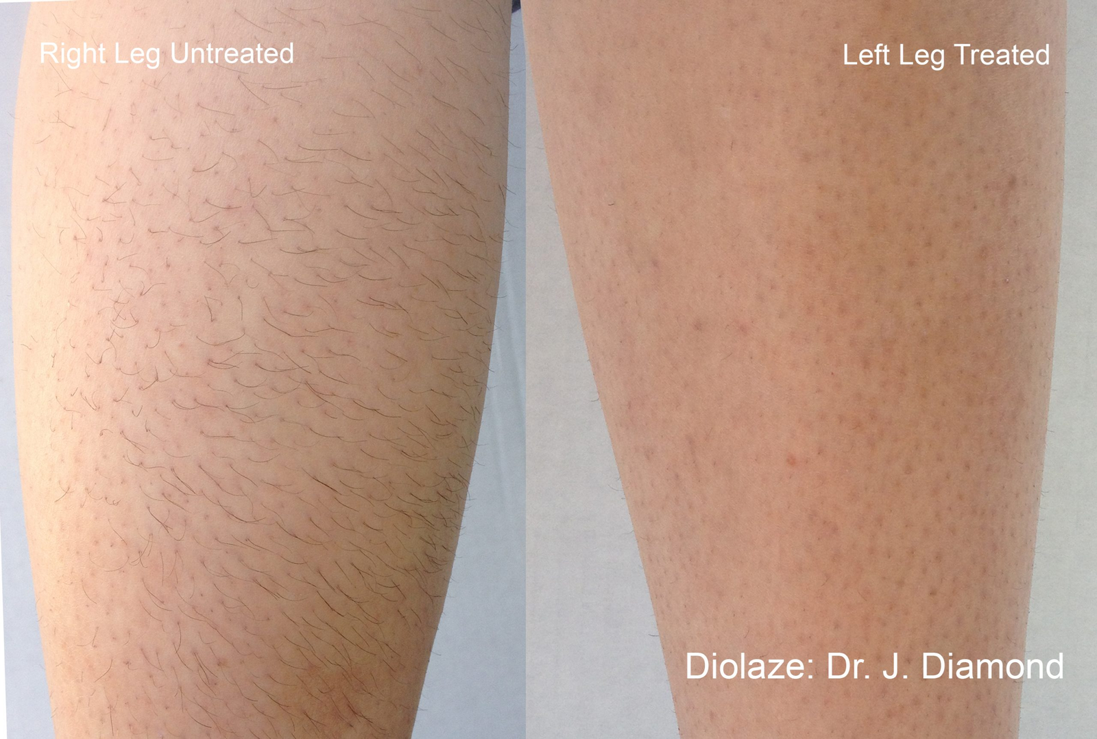 How Long Does Laser Hair Removal Last?: original before and after comparison