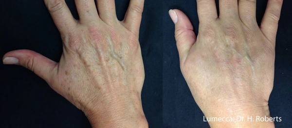 Lumecca IPL before and after example 37