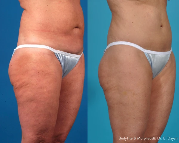 Morpheus8 body before and after example 20