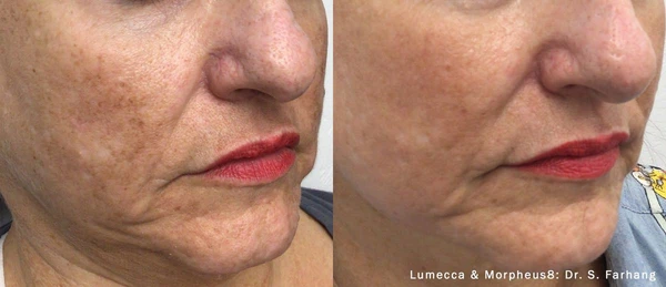 Lumecca IPL before and after example 4