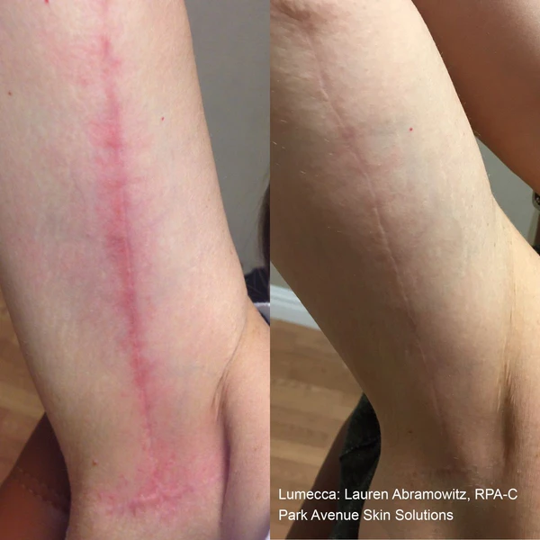 Lumecca IPL before and after example 40