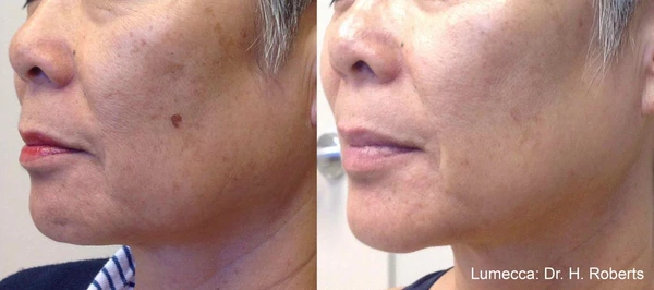 Lumecca IPL before and after example 30