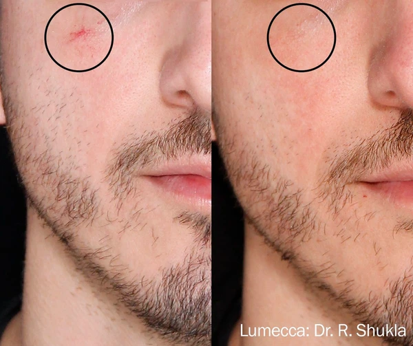 Lumecca IPL before and after example 21