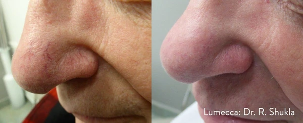 Lumecca IPL before and after example 16