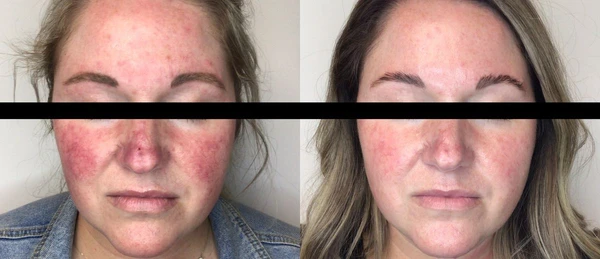 Lumecca IPL before and after example 11