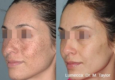 Lumecca IPL before and after example 10