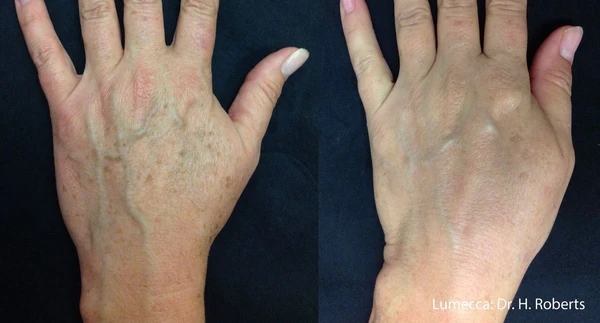 Lumecca IPL before and after example 2