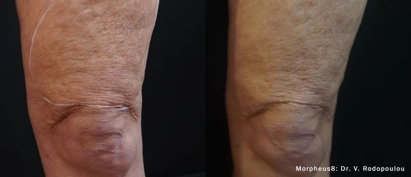 Morpheus8 body before and after example 18