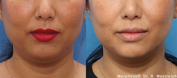 Morpheus8 face neck before and after example 7
