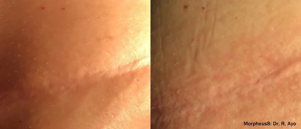 Morpheus8 body before and after example 21