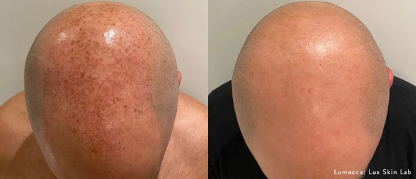 Lumecca IPL before and after example 33