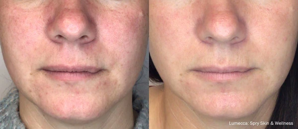Lumecca IPL before and after example 13