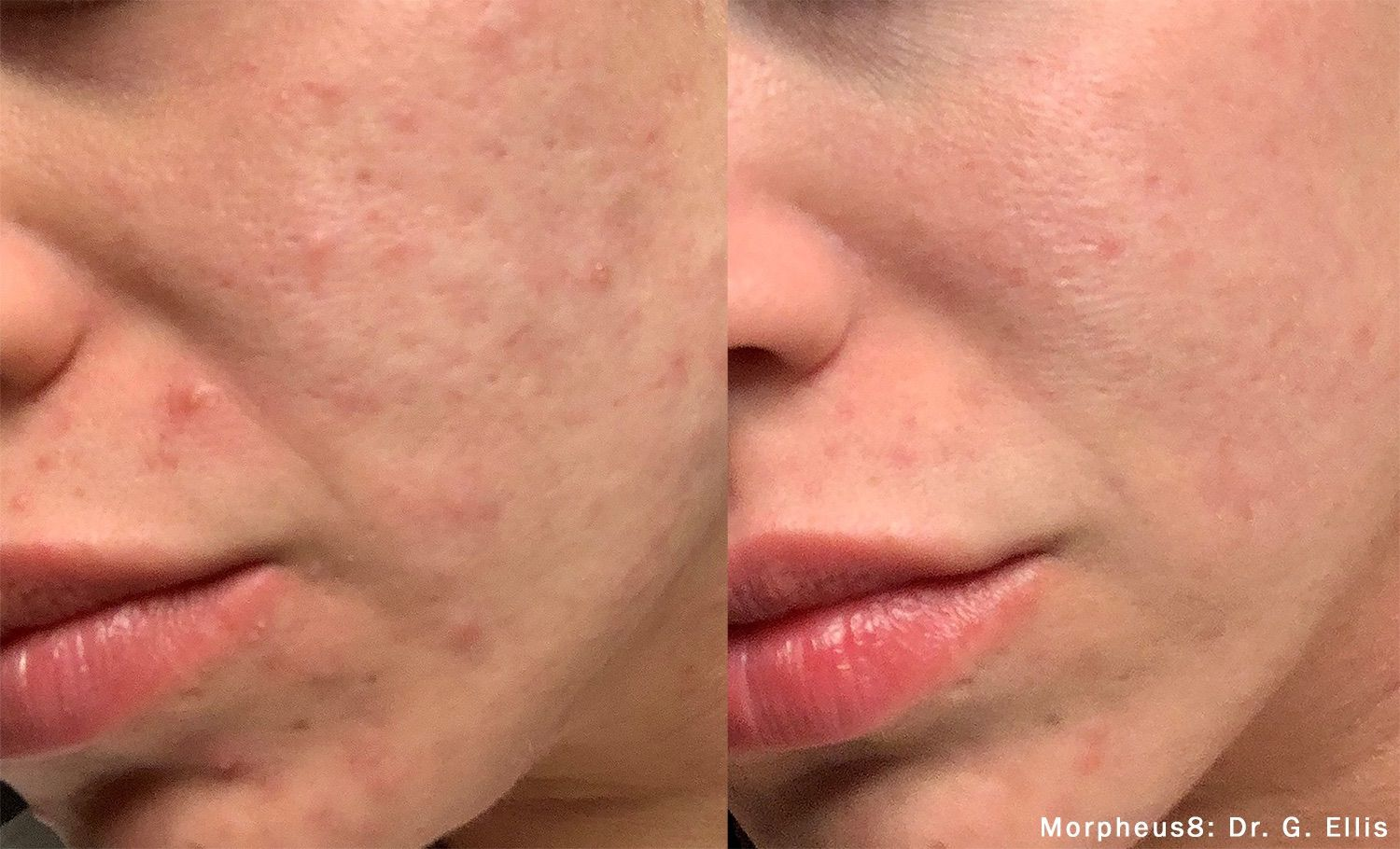 Skin Tightening: original before and after comparison