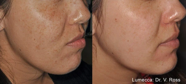Lumecca IPL before and after example 27