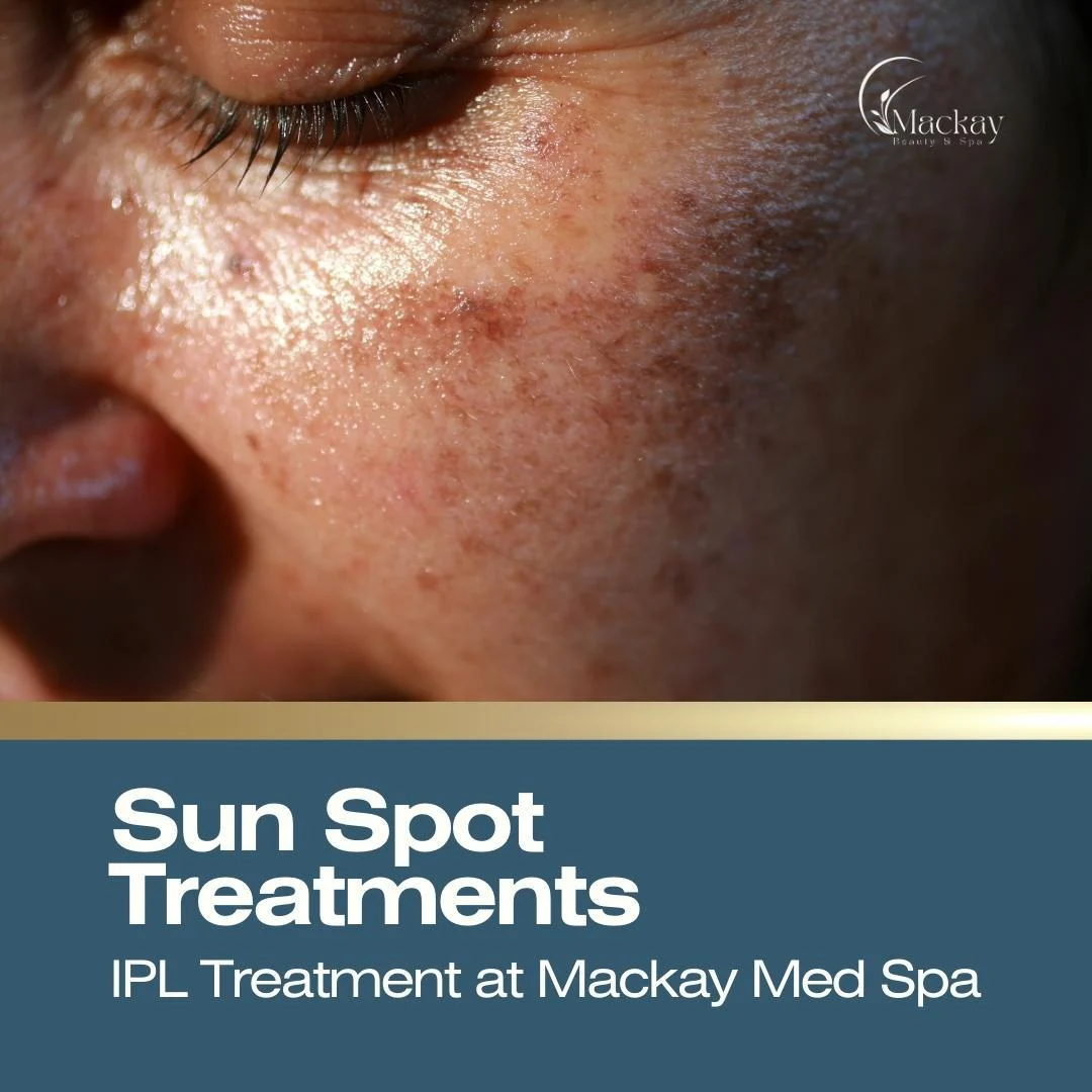 Everything You Should Know About Sun Spot Removal & Reduction with IPL Treatments: illustration from the practice guide
