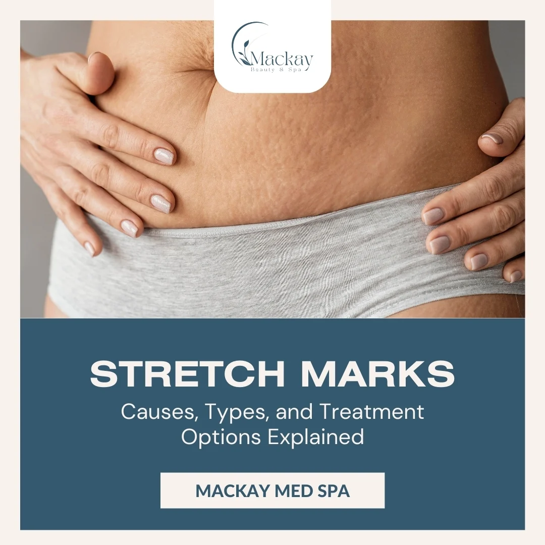 What Causes Stretch Marks and How They Can Be Treated: illustration from the practice guide