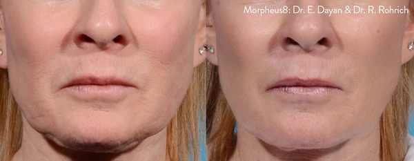 Morpheus8 face neck before and after example 10