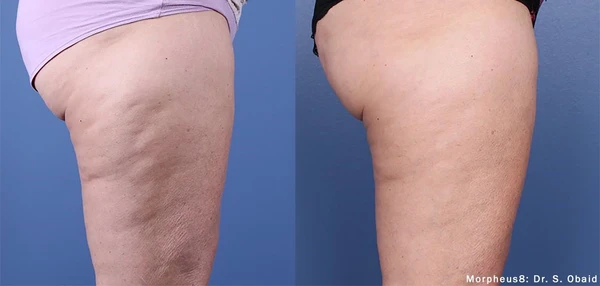 Morpheus8 body before and after example 22