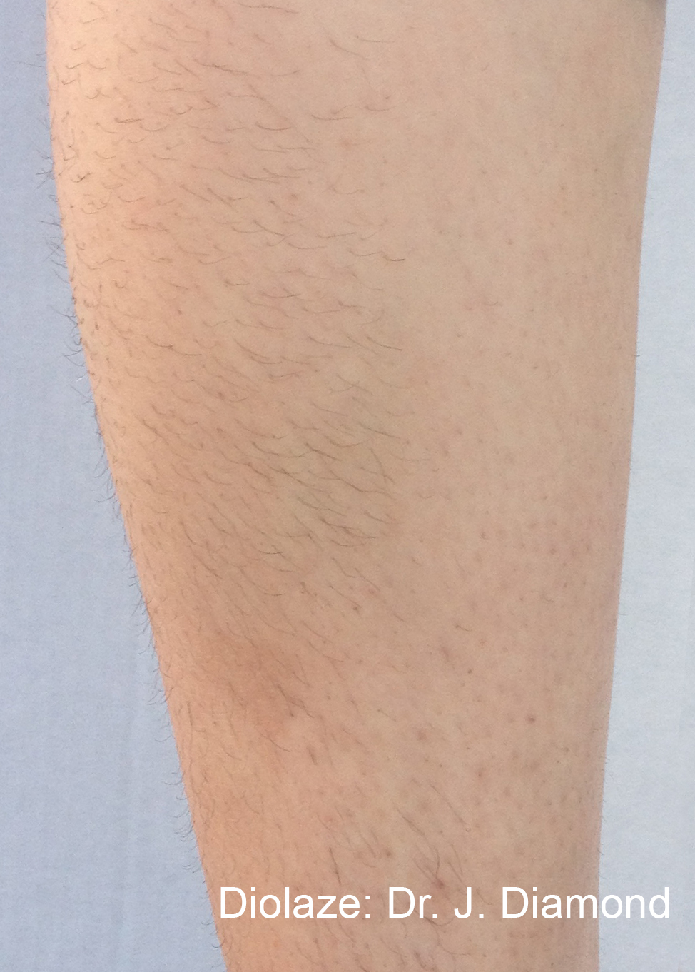 How Long Does Laser Hair Removal Last?: original before and after comparison