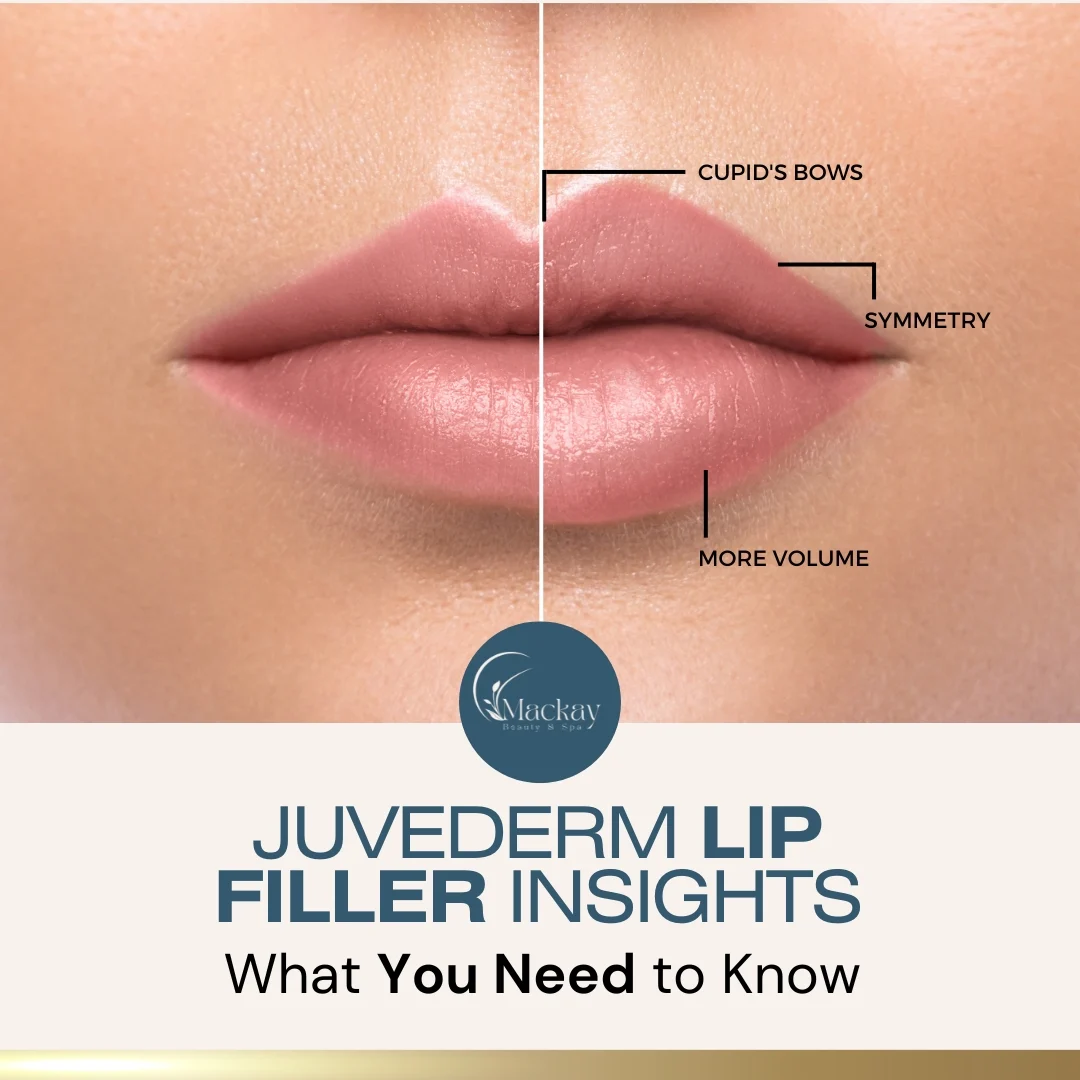 MMS-Juvederm-Lip-Filler-Insights