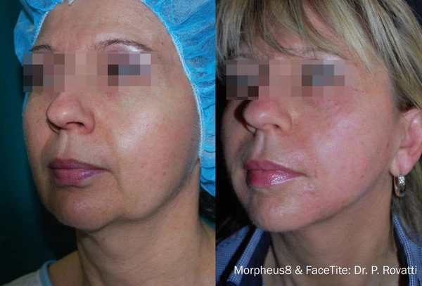 Morpheus8 face neck before and after example 12