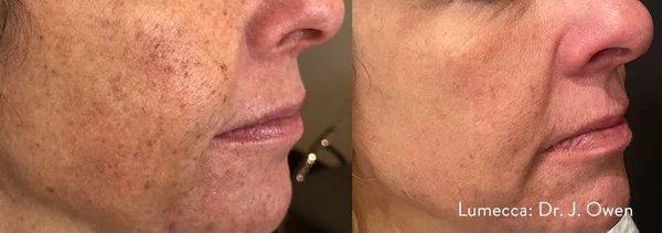 Lumecca IPL before and after example 31