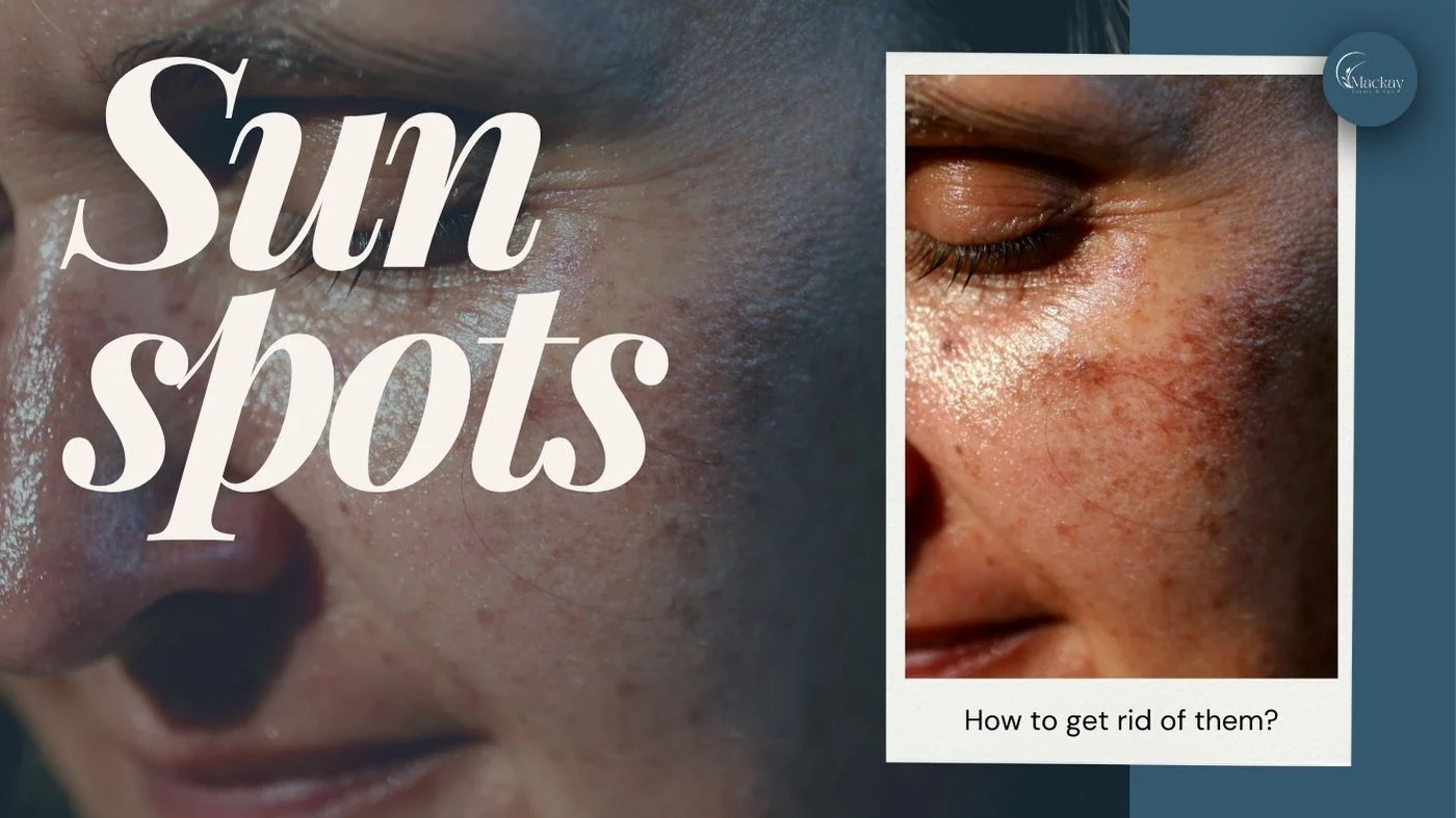 How to Get Rid of Sun Spots