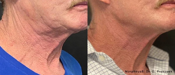 Morpheus8 face neck before and after example 11
