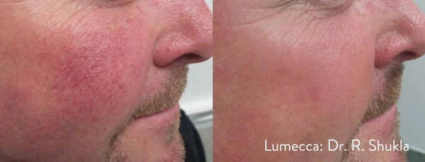 Lumecca IPL before and after example 19
