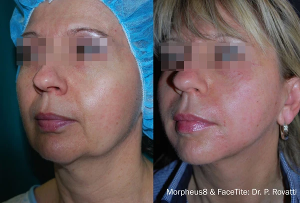 Morpheus8 face neck before and after example 9