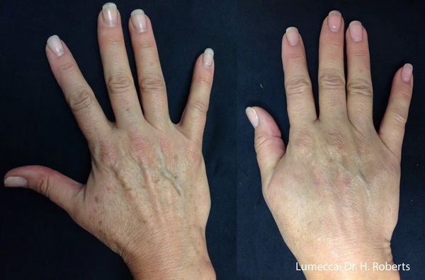 Lumecca IPL before and after example 38