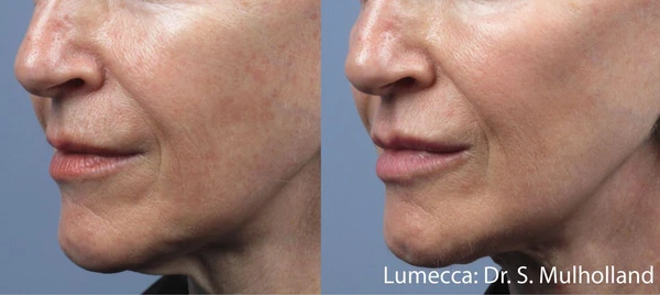 Lumecca IPL before and after example 1