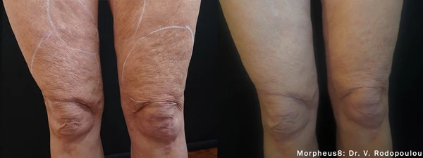 Morpheus8 body before and after example 16