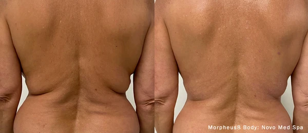 Morpheus8 body before and after example 14