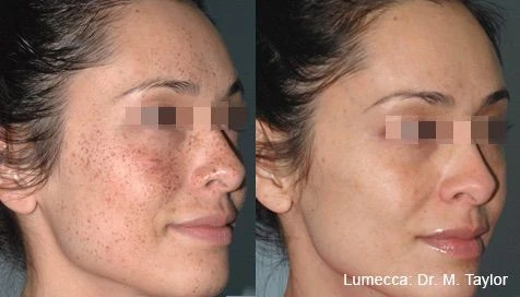 Lumecca IPL before and after example 8
