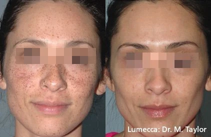 Lumecca IPL before and after example 9