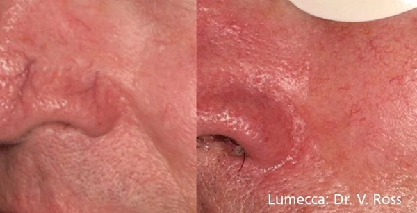 Lumecca IPL before and after example 23