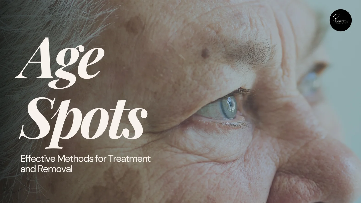 How to Get Rid of Age Spots