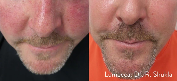 Lumecca IPL before and after example 17