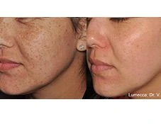 Lumecca IPL before and after example 41