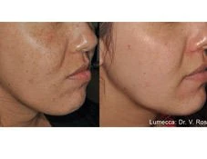 Lumecca IPL before and after example 26