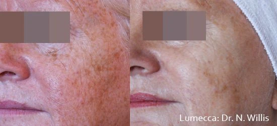 Lumecca IPL before and after example 7