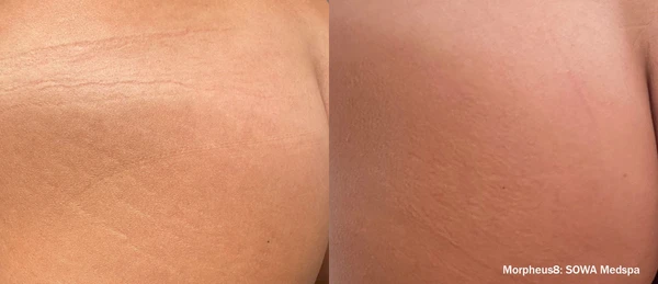 Morpheus8 body before and after example 23