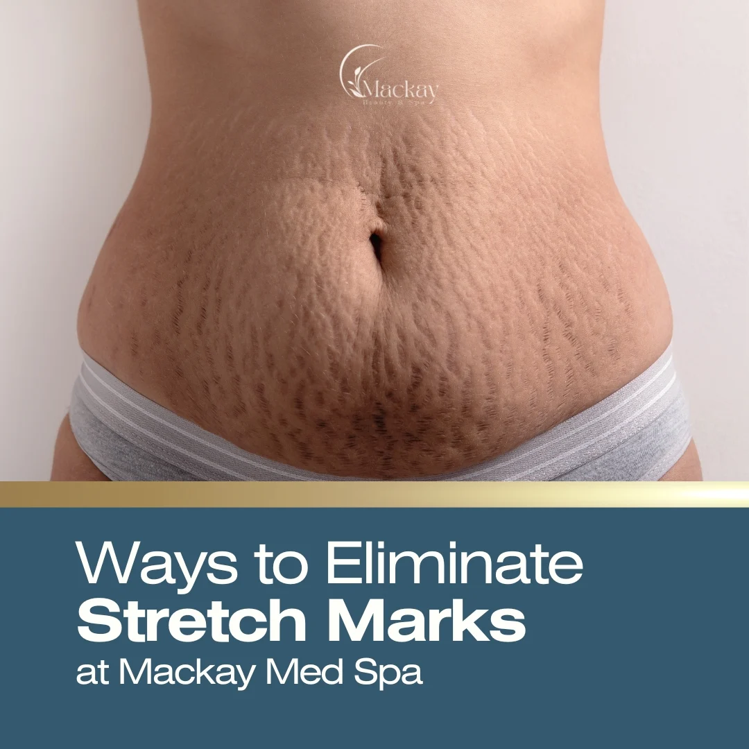 How to Get Rid of Stretch Marks: illustration from the practice guide