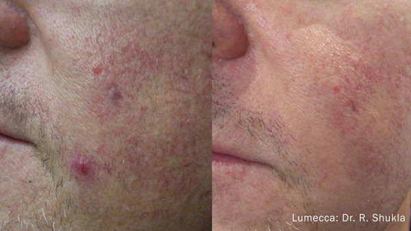 Lumecca IPL before and after example 20