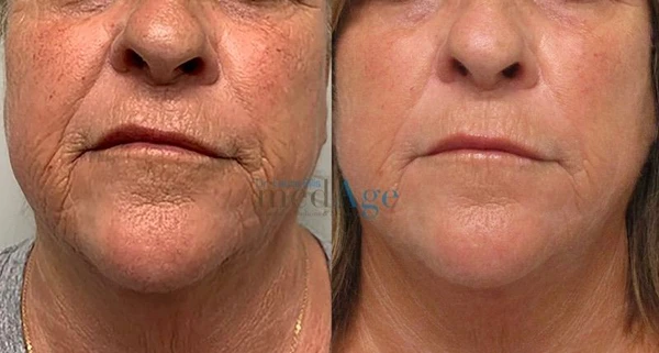 Morpheus8 face neck before and after example 13
